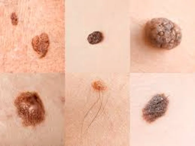 Skin Cancer Signs: What to Look For & When to See a Doctor