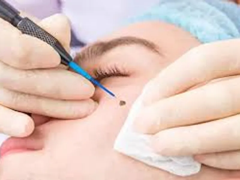 Mole Removal Near You: Expert Guide & Options