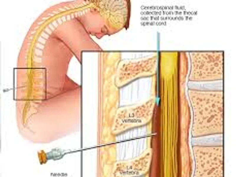 ADA CSF Test: What It Is & Why It's Vital