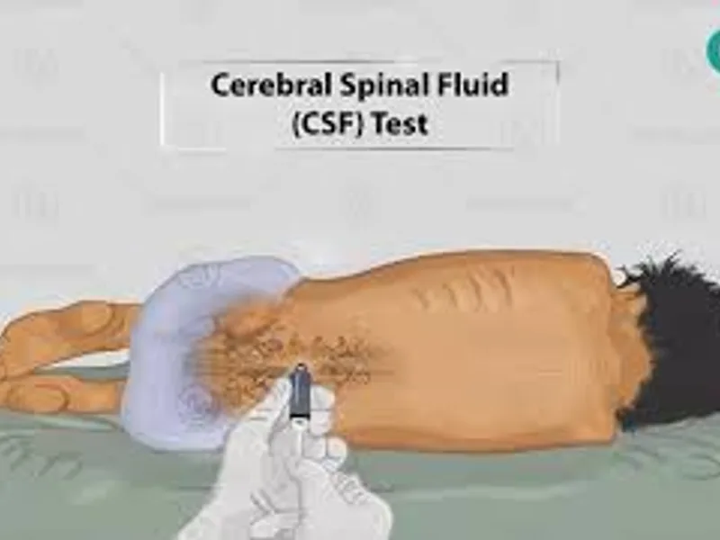 Protein CSF Test: What It Is, Why It's Done