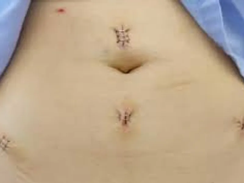 Ovarian Cyst Surgery Kolkata: Expert Care & Options