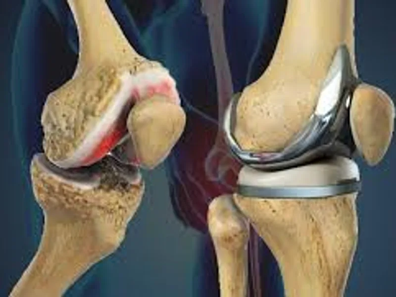 Knee Replacement Surgery Cost in Mumbai 2026
