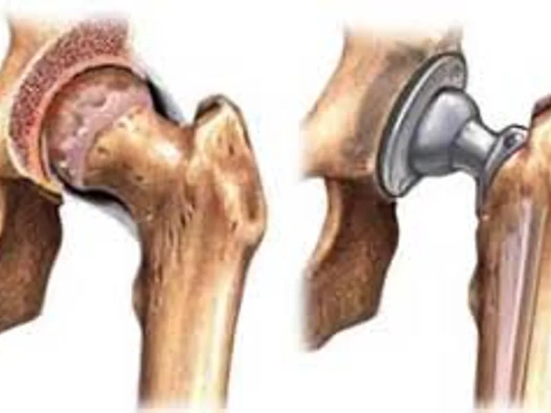 Hip Replacement Surgery Cost in Mumbai 2026 |hip replacement cost mumbai