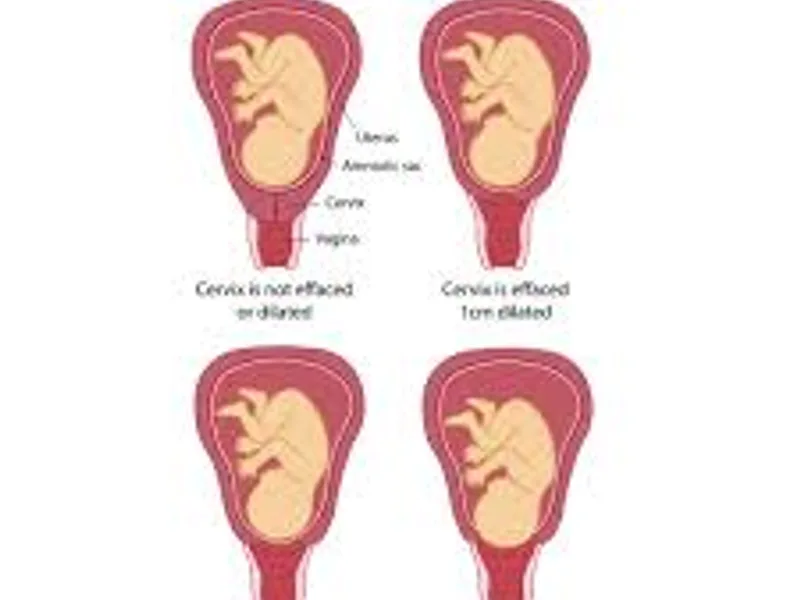 Cervix dilation no pain at 9 months: what it means