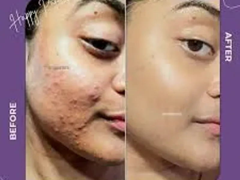 Pigmentation Treatment in Kolkata