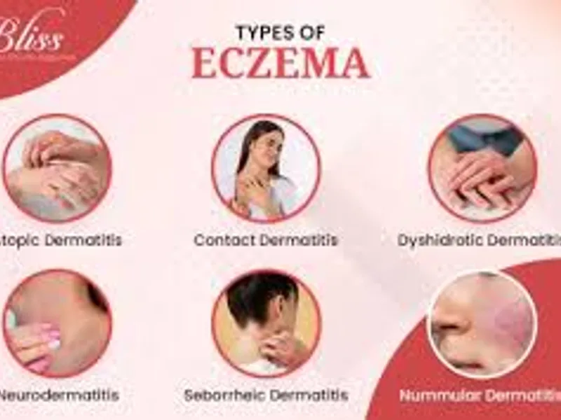 Best Eczema Doctor Near Me in Kolkata | Skin Care Guide