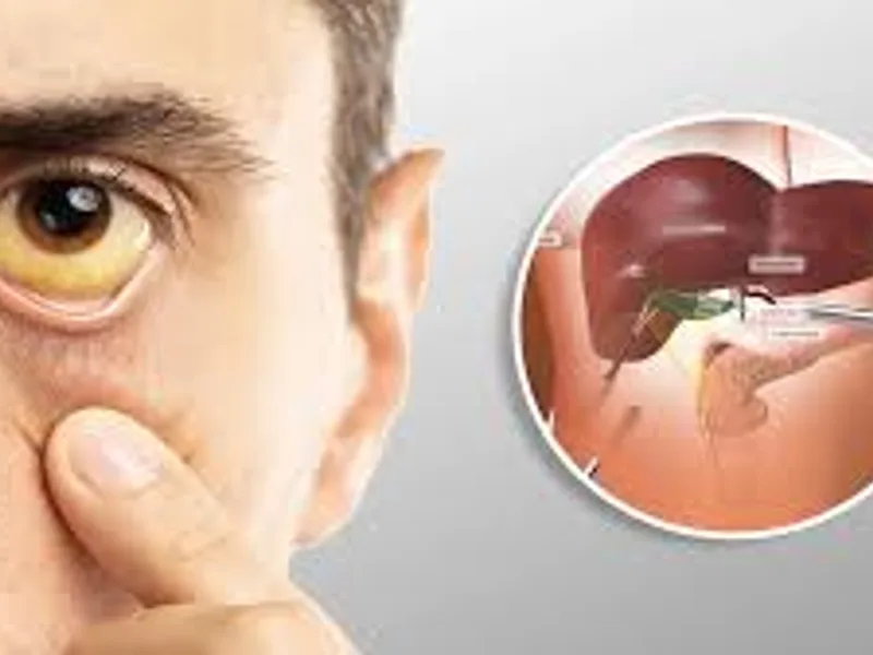 Best Jaundice Specialist in Kolkata | Expert Liver Care