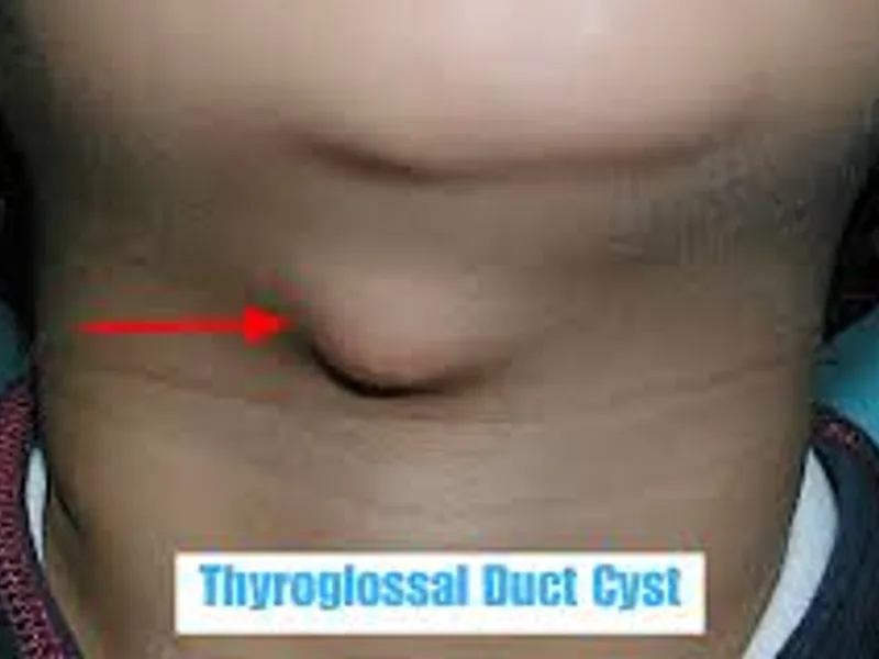 Excision of Branchial Cyst Surgery & Treatment in Deoghar