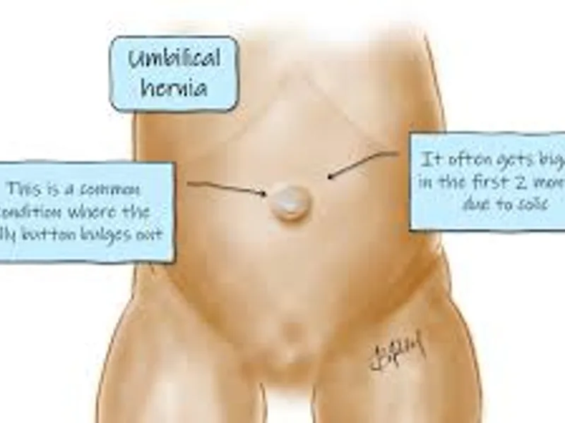 Inguinal Herniotomy (Child Hernia Surgery) in Deoghar