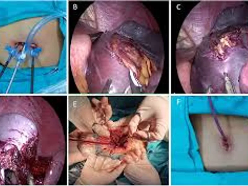 child Excision of Cyst in Deoghar