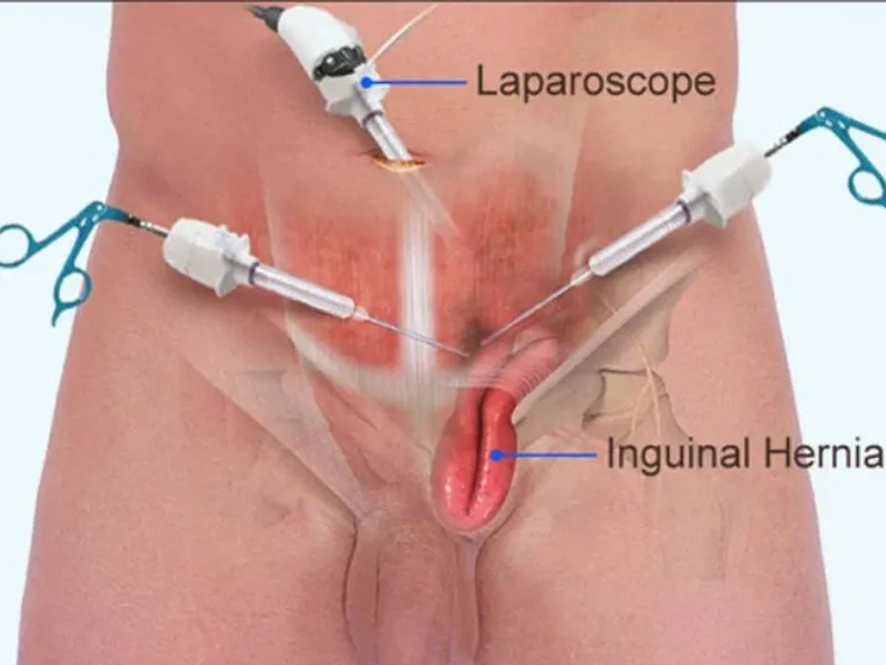Best Hernia Repair Cost in Deoghar