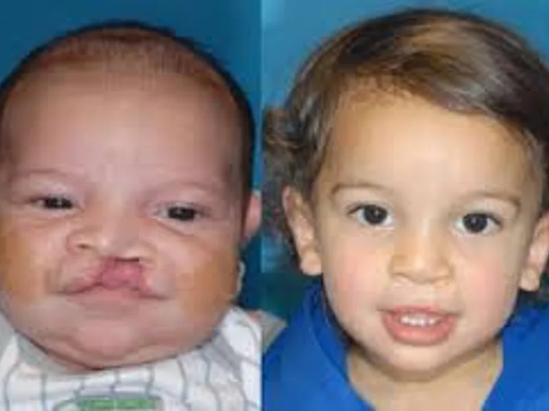 Best Child Excision repair surgery in Deoghar