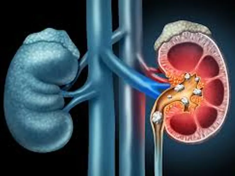 Kidney Stone Surgery in Deoghar