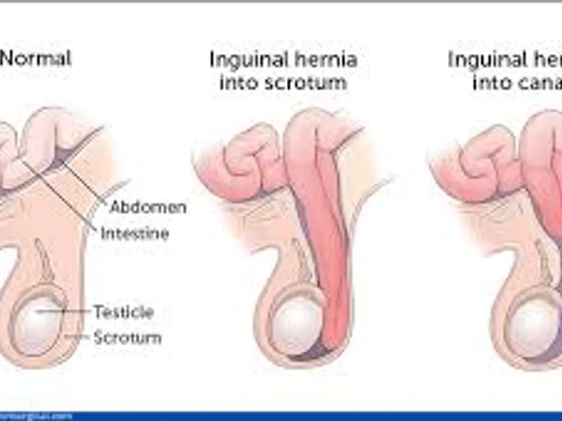 Inguinal Herniotomy Surgery in Deoghar | Best Hernia Surgeons