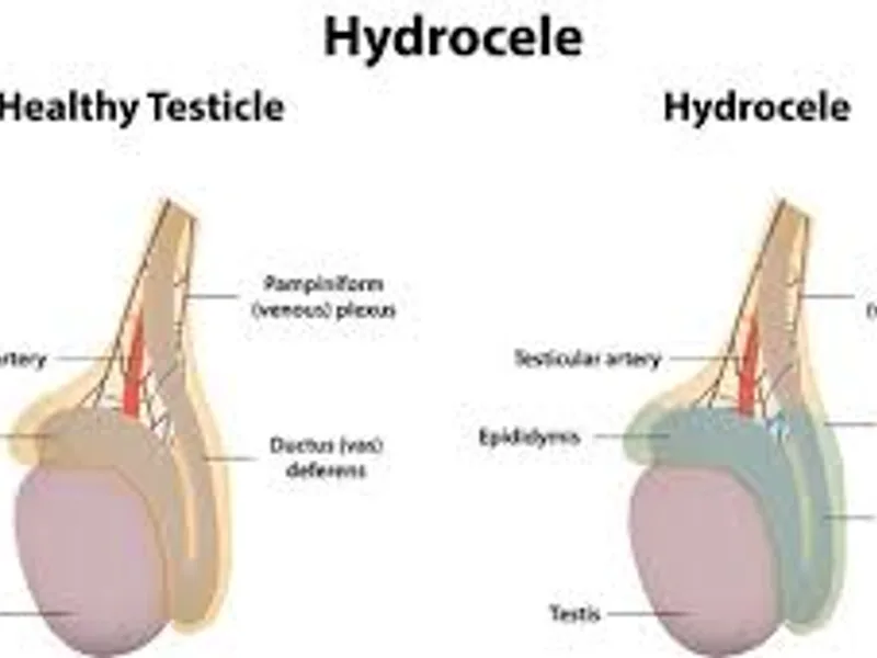 Congenital Hydrocele Surgery in Deoghar | Cost, Best Surgeons & Hydrocelectomy Treatment
