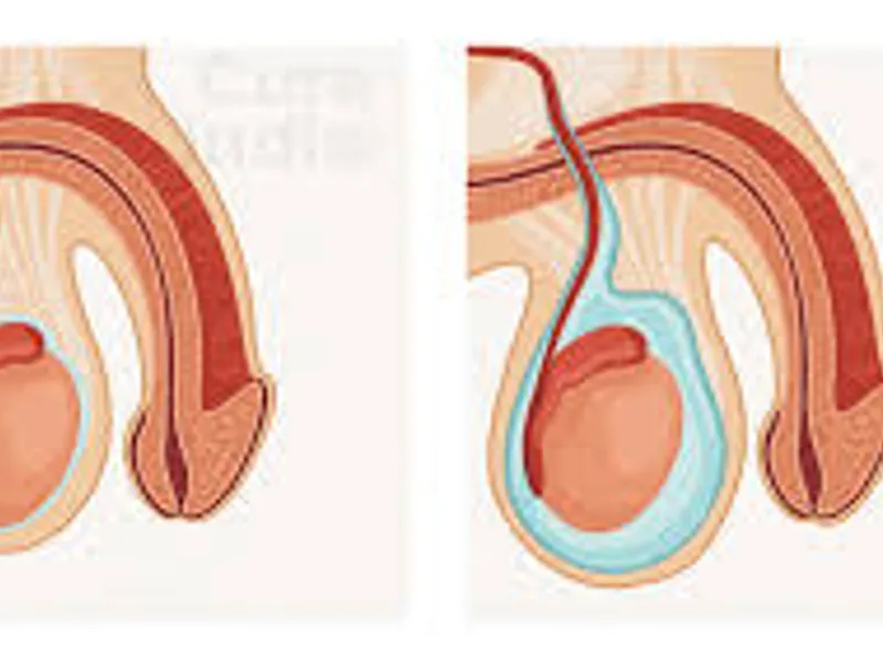 Hydrocele of Cord Surgery in Deoghar | Cost, Best Surgeons, Reviews & Treatment Guide