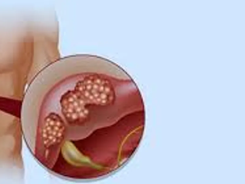 Excision of Cyst Surgery in Deoghar | Best Surgeons, Cost, Reviews & Cyst Removal Treatment