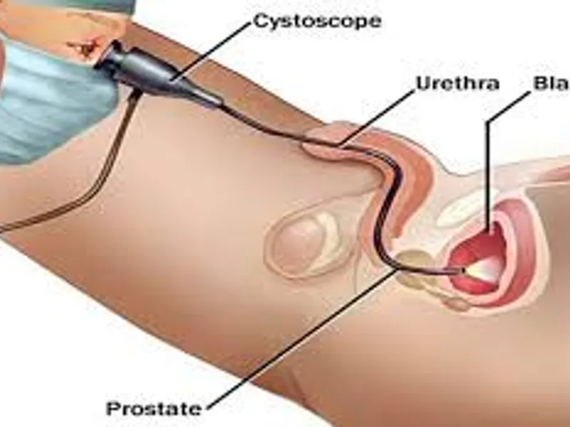 Cystoscopy Surgery in Deoghar | Best Urologists, Cost, Reviews & Treatment Guide