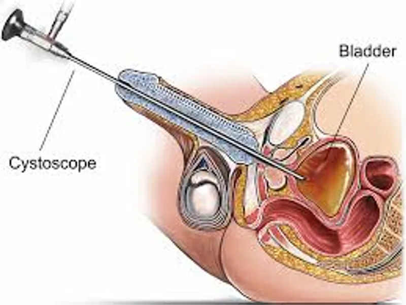 Child Cystoscopy Surgery in Deoghar