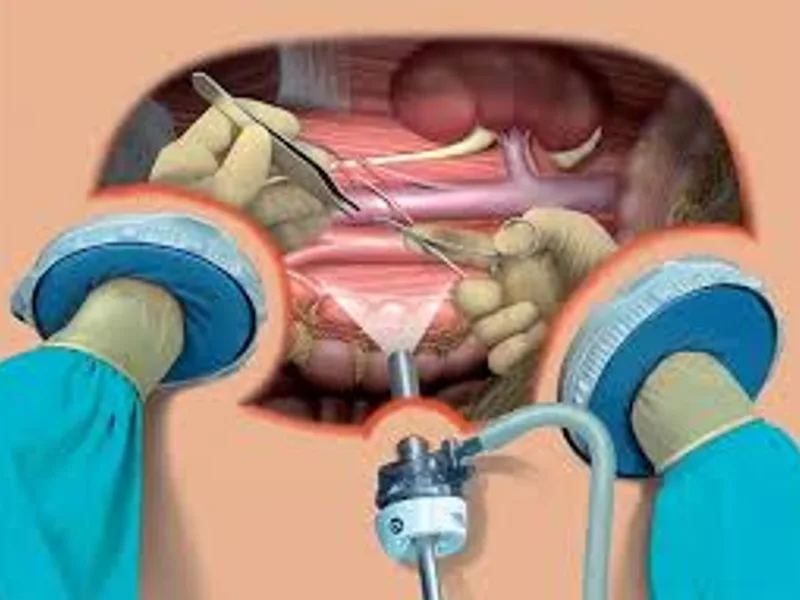 Diagnostic Laparoscopy Surgery in Deoghar