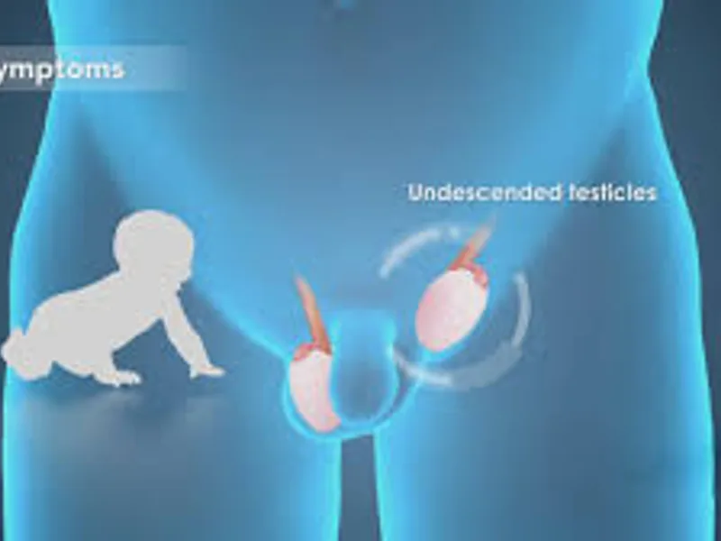 Child Undescended Testis Bilateral Surgery in Deoghar