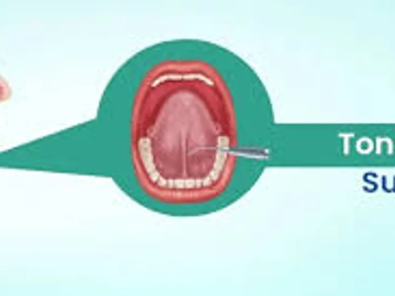 Tongue Tie Excision Surgery in Deoghar | Cost, Best Surgeons & Treatment Guide 2025