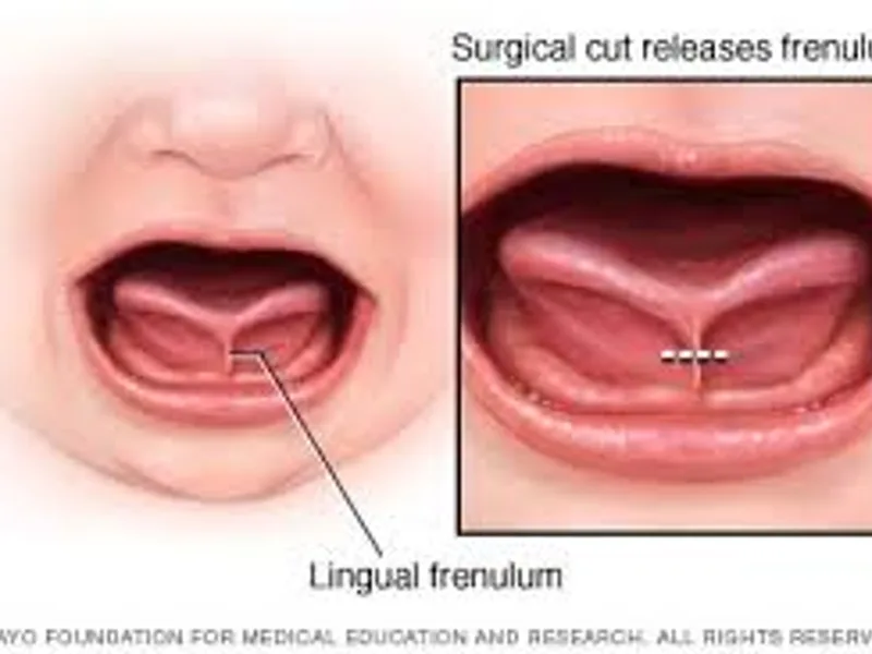 Child Tongue Tie Excision Surgery in Deoghar
