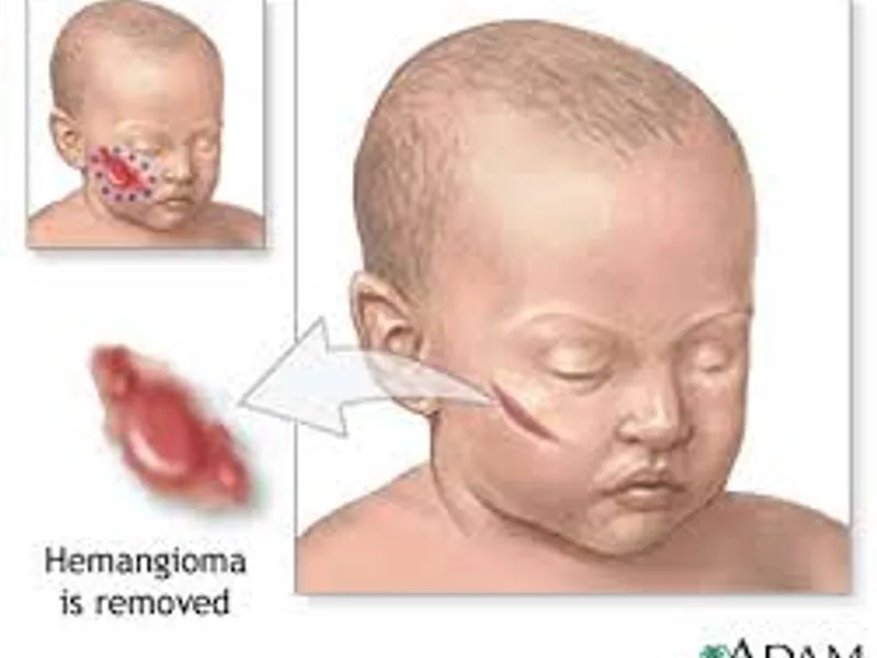 Child Excision of Hemangioma Surgery in Deoghar