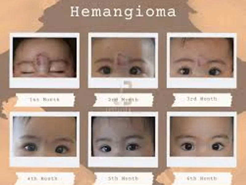 Excision of Hemangioma Surgery in Deoghar | Cost, Best Surgeons & Treatment Guide 2025