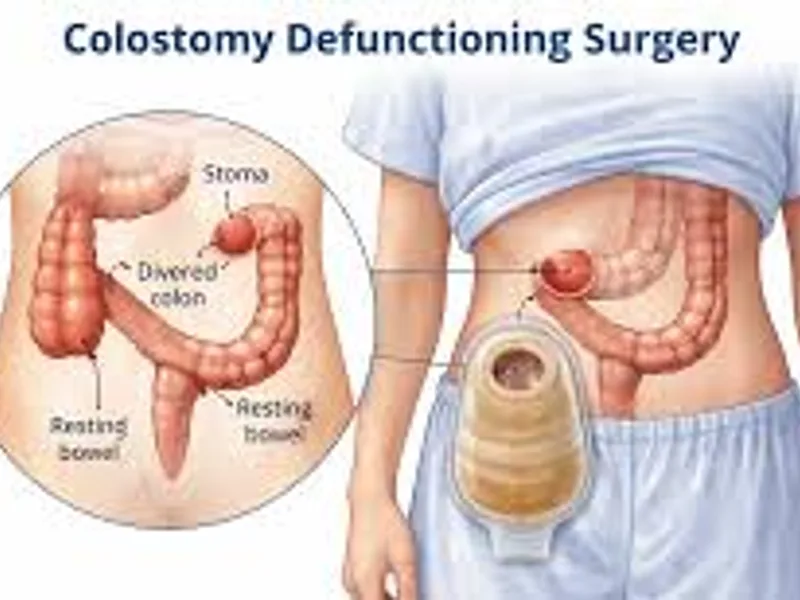 Child Colostomy Surgery in Deoghar
