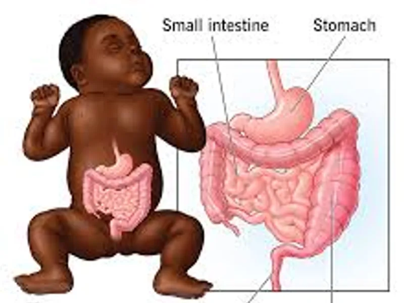 Child Colostomy with Multiple Biopsy for Hirschsprung Disease in Deoghar