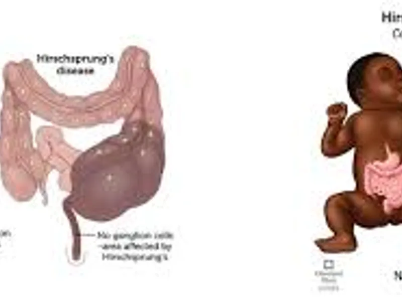 Colostomy with Multiple Biopsy for Hirschsprung Disease in Deoghar | Cost, Best Surgeons & Treatment Guide 2025