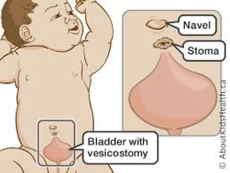 Child Vesicostomy Surgery in Deoghar