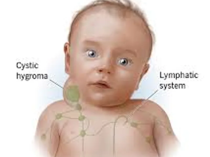 Child Excision of Cystic Hygroma Surgery in Deoghar