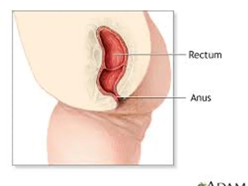 Child Imperforate Anus Low Anomaly Cut Back Operation in Deoghar