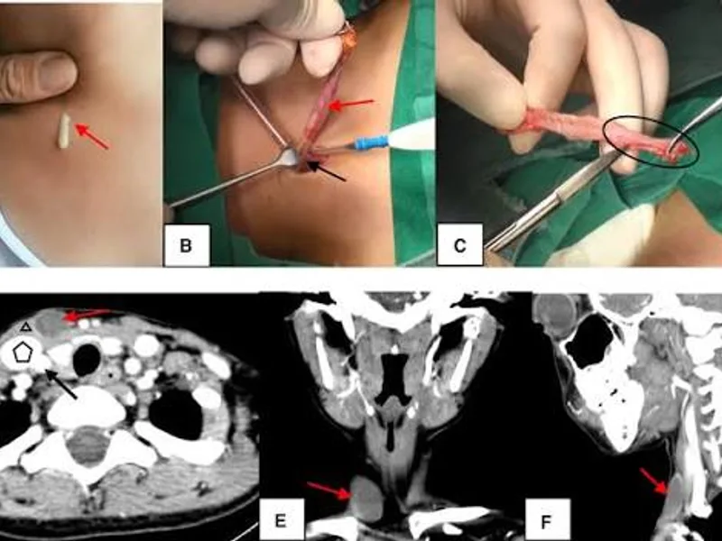Female Excision of Branchial Cyst Surgery in Deoghar
