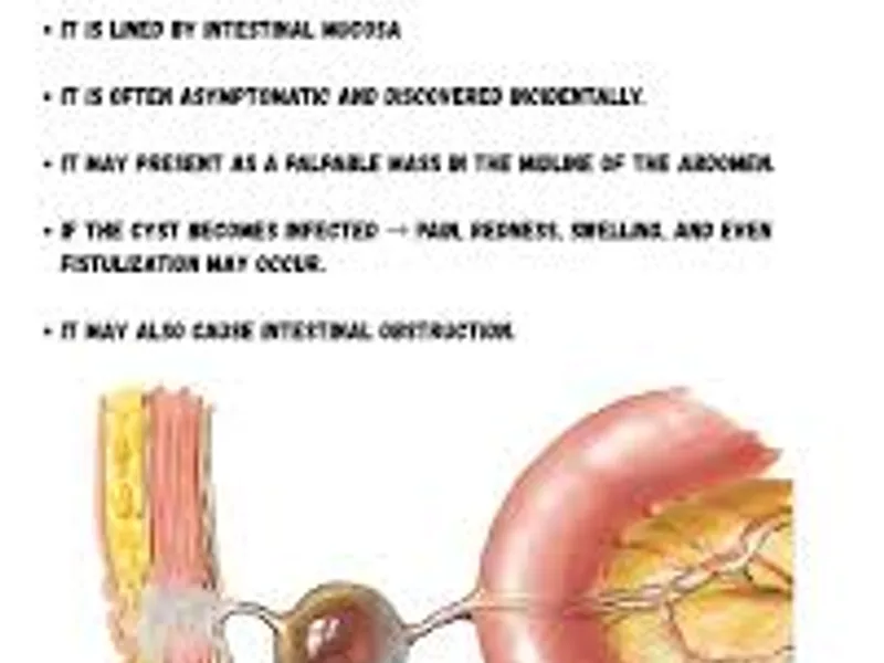 Child omphalo mesenteric cyst excision surgery in Deoghar