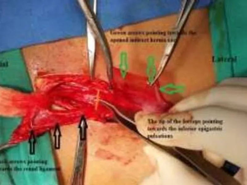 Female inguinal herniotomy surgery in Deoghar