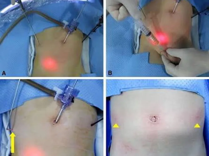 Female congenital hydrocele surgery in Deoghar