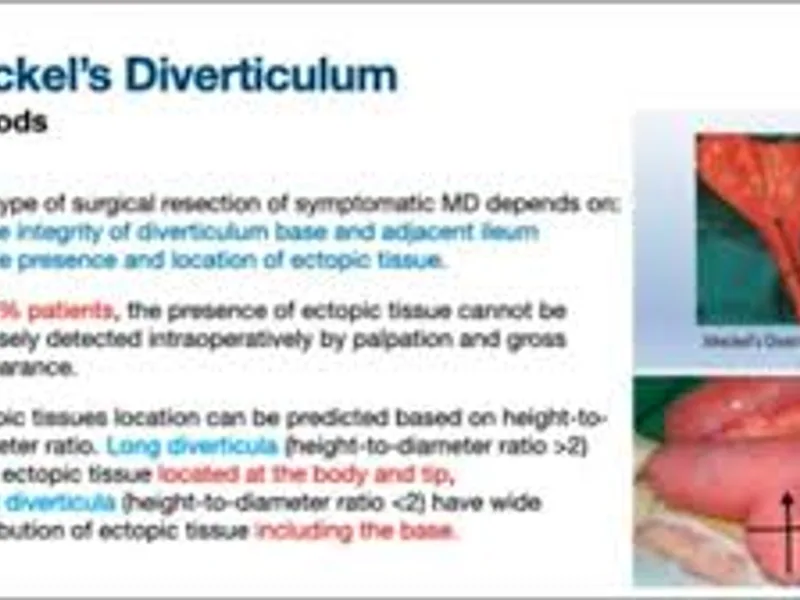 Meckel's Diverticulectomy Surgery in Deoghar | Cost, Best Surgeons & Treatment Guide 2025