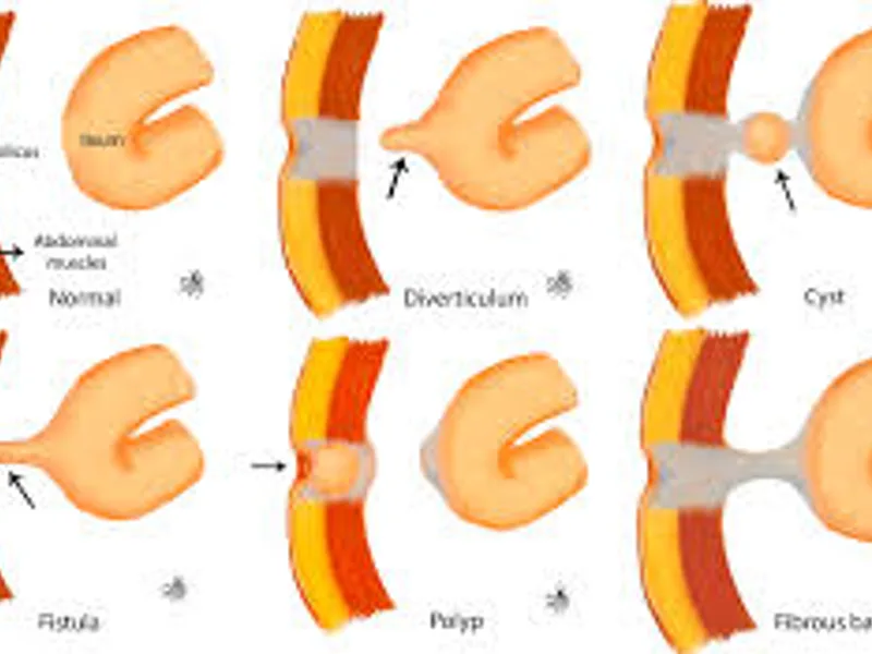 Child Omphalo Mesenteric Duct Excision Surgery in Deoghar