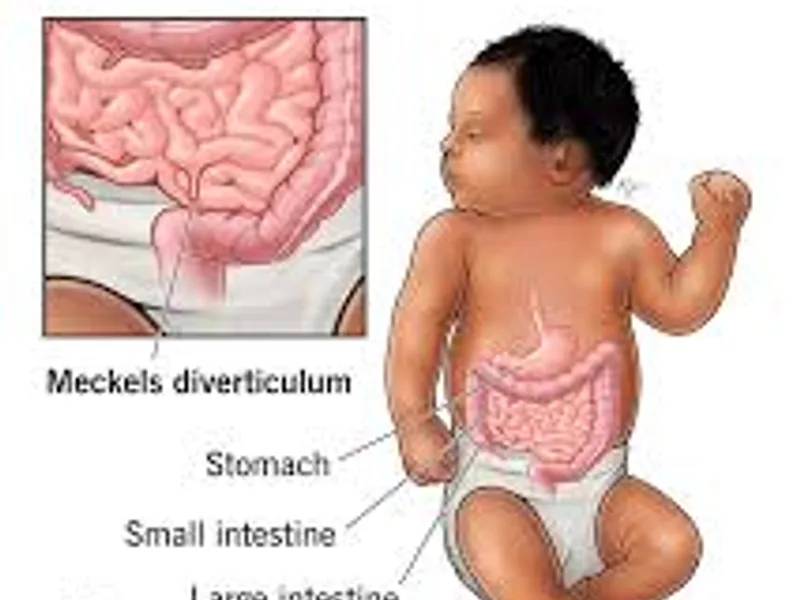 Child Meckel's Diverticulectomy Surgery in Deoghar