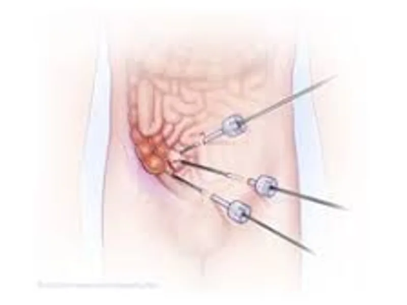 Child Open Appendectomy Surgery in Deoghar