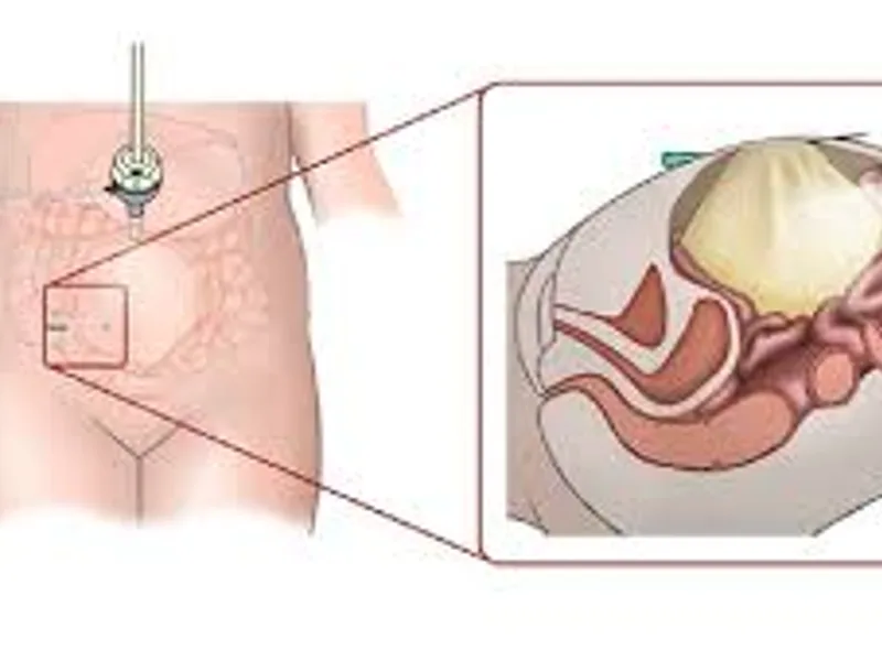Child Open Abdominal Cyst Operation in Deoghar
