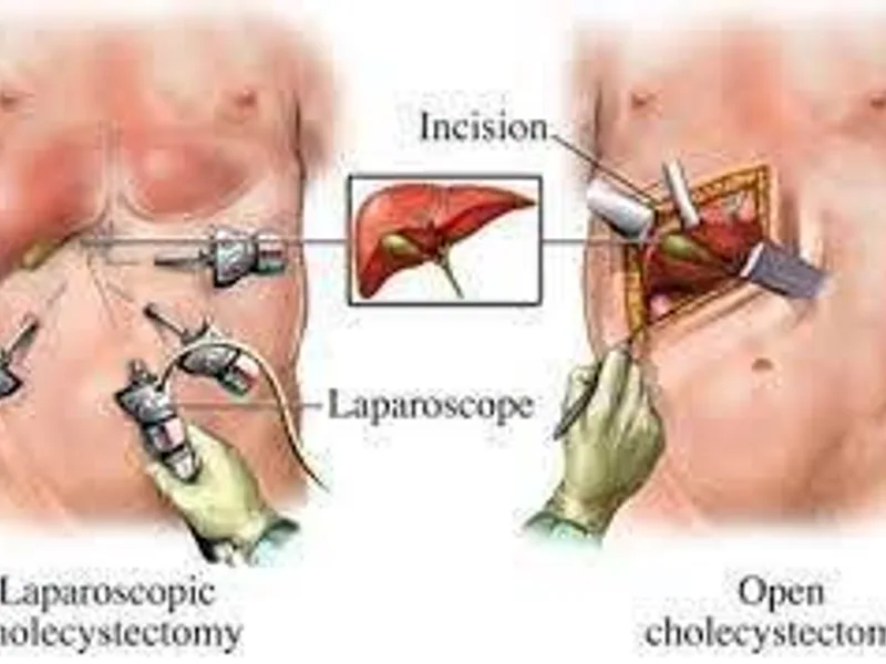 Laparoscopic Cholecystectomy Surgery in Deoghar | Cost, Best Surgeons & Gallstone Treatment Guide 2025