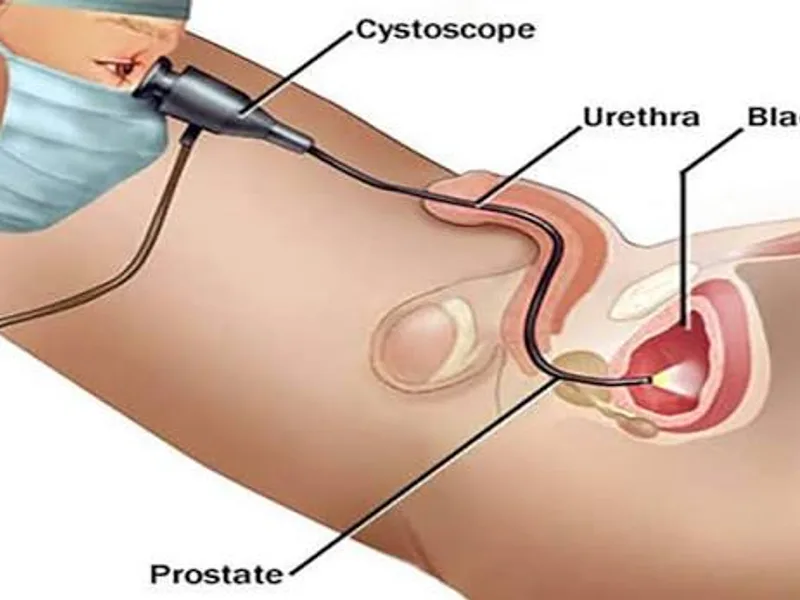 Female Cystoscopy Surgery in Deoghar