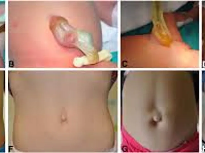 Omphalocele First Stage Hernia Repair Surgery in Deoghar | Cost, Best Pediatric Surgeons & Treatment Guide