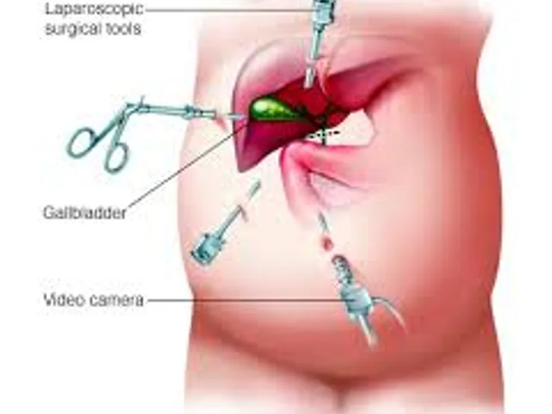 Child Laparoscopic Cholecystectomy Surgery in Deoghar