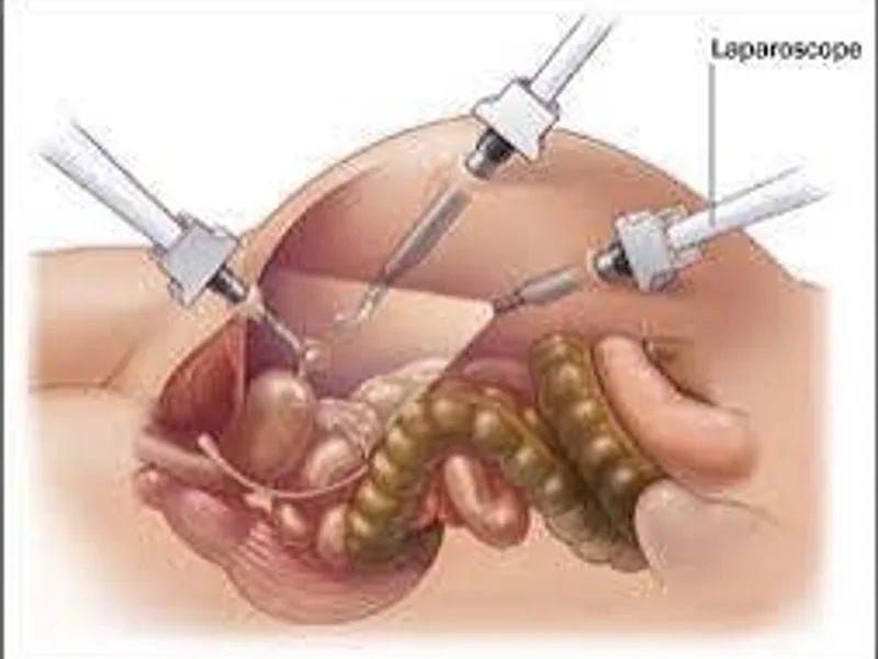 Female Diagnostic Laparoscopy Surgery in Deoghar