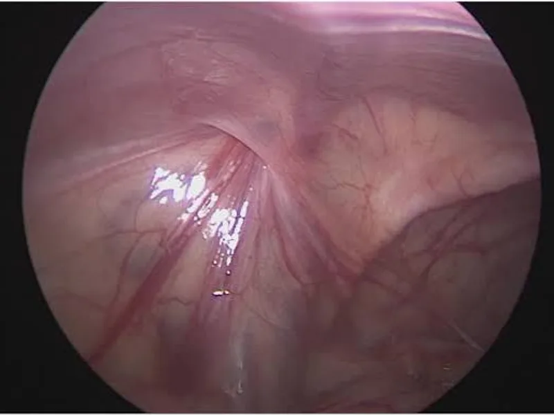 Female Laparoscopic Orchidopexy Surgery in Deoghar